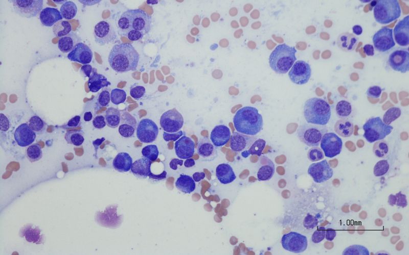 Myelogram © Dre Audrey Simon, Hematologist in Geneva
