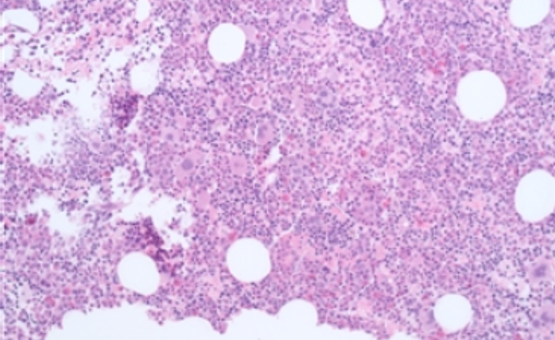 Bone marrow biopsy © Dre Audrey Simon, Hematologist in Geneva
